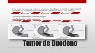Tumor de Duodeno
Es un tumor muy raro, que contacta o compromete parcialmente la ampolla o papila duodenal,
ocasionando una leve dilatación del conducto biliar o pancreático, la cual a veces no sucede.
La clasificación morfológica comprende los tipos:
polipoide, fungoide y anular constrictivo.
 