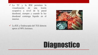 Diagnostico
 La TC y la RM permiten la
visualización de una lesión
ocupativa a nivel de la pared
duodenal, siempre y cuando la luz
duodenal contenga líquido en el
interior.
 La RX y Endoscopia del TGI detecta
aprox el 90% lesiones.
 