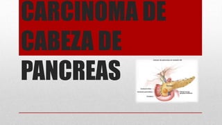 CARCINOMA DE
CABEZA DE
PANCREAS
 