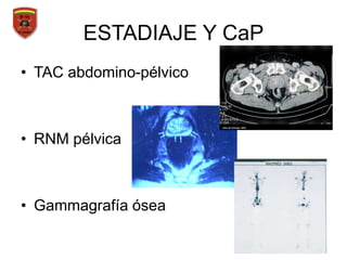 ESTADIAJE Y CaP
• TAC abdomino-pélvico
• RNM pélvica
• Gammagrafía ósea
 