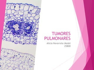 TUMORES
PULMONARES
Alicia Navarrete Medel
25800
 