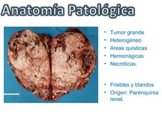 •   Tumor grande
•   Heterogéneo
•   Areas quísticas
•   Hemorrágicas
•   Necróticas.


• Friables y blandos
• Origen: Parénquima
  renal.
 