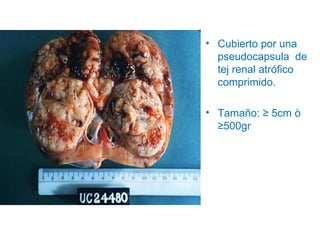 • Cubierto por una
  pseudocapsula de
  tej renal atrófico
  comprimido.

• Tamaño: ≥ 5cm ò
  ≥500gr
 