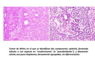 Tumor de Wilms en el que se identifican dos componente: epitelial, formando
túbulos o con aspecto en "seudorrosetas" (o "pseudotúbulos"), y blastemal:
células con poco citoplasma, densamente agrupadas, sin diferenciación.
 
