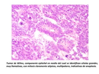 Tumor de Wilms, componente epitelial en medio del cual se identifican células grandes,
muy llamativas, con mitosis claramente atípicas, multipolares, indicativas de anaplasia.
 