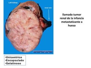llamado tumor
renal de la infancia
 metastatizante a
       hueso
 
