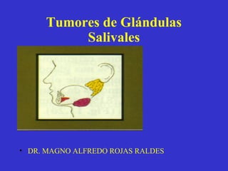 Tumores de Glándulas
Salivales
• D
• DR. MAGNO ALFREDO ROJAS RALDES
 