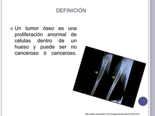 DEFINICIÓN


   Un tumor óseo es una
    proliferación anormal de
    células dentro de un
    hueso y puede ser no
    canceroso ó canceroso.




                               http://www.clinicadam.com/imagenes-de-salud/1233.html
 