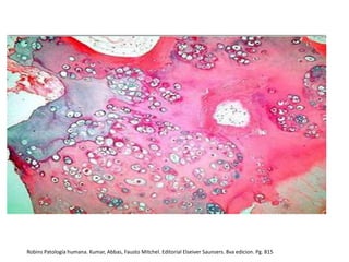 Robins Patología humana. Kumar, Abbas, Fausto Mitchel. Editorial Elseiver Saunsers. 8va edicion. Pg. 815

 