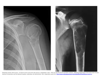 Radiology assitant. Bone tumor - A-G Bone tumors and tumor-like lesions in alphabethic order . Henk Jan van de Woude and Robin Smithuis . Radiology department of the Onze Lieve Vrouwe
Gasthuis, Amsterdam and the Rijnland hospital, Leiderdorp, the Netherlands. 2011. Disponible a partir de: http://www.radiologyassistant.nl/en/p4bc9b15f76a78/bone-tumor-a-

 