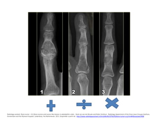 Radiology assitant. Bone tumor - A-G Bone tumors and tumor-like lesions in alphabethic order . Henk Jan van de Woude and Robin Smithuis . Radiology department of the Onze Lieve Vrouwe Gasthuis,
Amsterdam and the Rijnland hospital, Leiderdorp, the Netherlands. 2011. Disponible a partir de: http://www.radiologyassistant.nl/en/p4bc9b15f76a78/bone-tumor-a-g.html#i4bcaa2aed7898

 