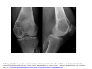 Radiology assitant. Bone tumor - A-G Bone tumors and tumor-like lesions in alphabethic order . Henk Jan van de Woude and Robin Smithuis .
Radiology department of the Onze Lieve Vrouwe Gasthuis, Amsterdam and the Rijnland hospital, Leiderdorp, the Netherlands. 2011. Disponible a
partir de: http://www.radiologyassistant.nl/en/p4bc9b15f76a78/bone-tumor-a-g.html#i4bcaa2aed7898

 