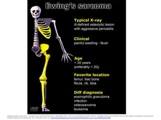 Radiology assitant. Bone tumor - A-G Bone tumors and tumor-like lesions in alphabethic order . Henk Jan van de Woude and Robin Smithuis . Radiology department of the Onze Lieve Vrouwe Gasthuis, Amsterdam and the Rijnland
hospital, Leiderdorp, the Netherlands. 2011. Disponible a partir de: http://www.radiologyassistant.nl/en/p4bc9b15f76a78/bone-tumor-a-g.html#i4bcaa2aed7898

 