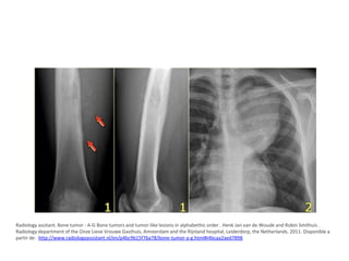 Radiology assitant. Bone tumor - A-G Bone tumors and tumor-like lesions in alphabethic order . Henk Jan van de Woude and Robin Smithuis .
Radiology department of the Onze Lieve Vrouwe Gasthuis, Amsterdam and the Rijnland hospital, Leiderdorp, the Netherlands. 2011. Disponible a
partir de: http://www.radiologyassistant.nl/en/p4bc9b15f76a78/bone-tumor-a-g.html#i4bcaa2aed7898

 