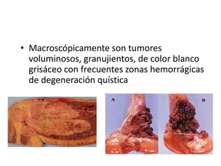• Macroscópicamente son tumores
voluminosos, granujientos, de color blanco
grisáceo con frecuentes zonas hemorrágicas
de degeneración quística

 