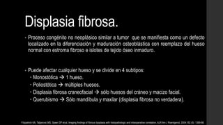 Displasia fibrosa.
• Proceso congénito no neoplásico similar a tumor que se manifiesta como un defecto
localizado en la diferenciación y maduración osteoblástica con reemplazo del hueso
normal con estroma fibroso e islotes de tejido óseo inmaduro.
• Puede afectar cualquier hueso y se divide en 4 subtipos:
 Monostótica  1 hueso.
 Poliostótica  múltiples huesos.
 Displasia fibrosa craneofacial  sólo huesos del cráneo y macizo facial.
 Querubismo  Sólo mandíbula y maxilar (displasia fibrosa no verdadera).
Fitzpatrick KA, Taljanovic MS, Speer DP et-al. Imaging findings of fibrous dysplasia with histopathologic and intraoperative correlation. AJR Am J Roentgenol. 2004;182 (6): 1389-98.
 