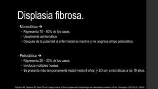 Displasia fibrosa.
• Monostótica 
 Representa 70 – 80% de los casos.
 Usualmente asintomático.
 Después de la pubertad la enfermedad es inactiva y no progresa al tipo poliostótico.
• Poliostótica 
 Representa 20 – 30% de los casos.
 Involucra múltiples huesos.
 Se presenta más tempranamente (edad media 8 años) y 2/3 son sintomáticas a los 10 años.
Fitzpatrick KA, Taljanovic MS, Speer DP et-al. Imaging findings of fibrous dysplasia with histopathologic and intraoperative correlation. AJR Am J Roentgenol. 2004;182 (6): 1389-98.
 