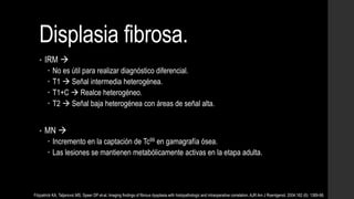 Displasia fibrosa.
• IRM 
 No es útil para realizar diagnóstico diferencial.
 T1  Señal intermedia heterogénea.
 T1+C  Realce heterogéneo.
 T2  Señal baja heterogénea con áreas de señal alta.
• MN 
 Incremento en la captación de Tc99 en gamagrafía ósea.
 Las lesiones se mantienen metabólicamente activas en la etapa adulta.
Fitzpatrick KA, Taljanovic MS, Speer DP et-al. Imaging findings of fibrous dysplasia with histopathologic and intraoperative correlation. AJR Am J Roentgenol. 2004;182 (6): 1389-98.
 
