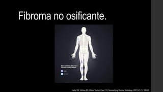 Fibroma no osificante.
Hetts SW, Hilchey SD, Wilson R et-al. Case 110: Nonossifying fibroma. Radiology. 2007;243 (1): 288-92.
 
