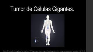 Tumor de Células Gigantes.
Murphey MD, Nomikos GC, Flemming DJ et-al. From the archives of AFIP. Imaging of giant cell tumor and giant cell reparative granuloma of bone: radiologic-pathologic correlation. Radiographics. 21 (5): 1283-309.
 