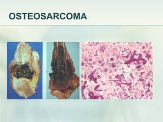 OSTEOSARCOMA 
