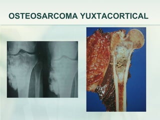 OSTEOSARCOMA YUXTACORTICAL 