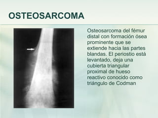 OSTEOSARCOMA Osteosarcoma del fémur distal con formación ósea prominente que se extiende hacia las partes blandas. El periostio está levantado, deja una cubierta triangular proximal de hueso reactivo conocido como triángulo de Codman 