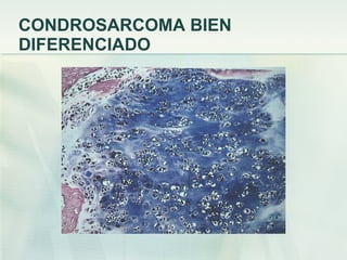 CONDROSARCOMA BIEN DIFERENCIADO 