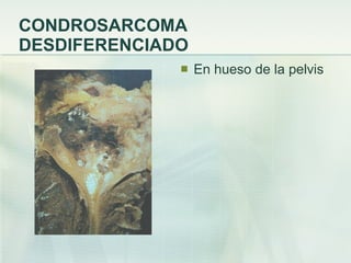 CONDROSARCOMA DESDIFERENCIADO En hueso de la pelvis 