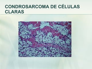 CONDROSARCOMA DE CÉLULAS CLARAS 
