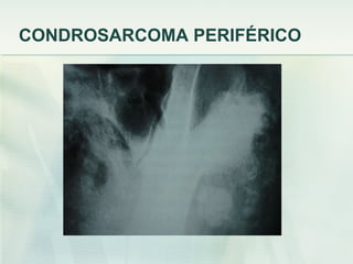 CONDROSARCOMA PERIFÉRICO 