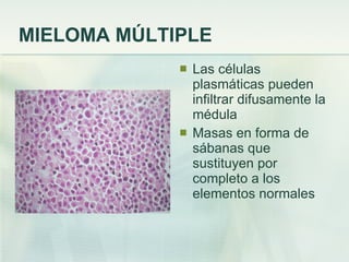 MIELOMA MÚLTIPLE Las células plasmáticas pueden infiltrar difusamente la médula Masas en forma de sábanas que sustituyen por completo a los elementos normales 