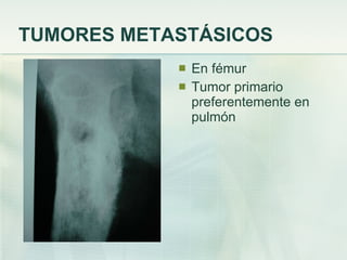 TUMORES METASTÁSICOS En fémur  Tumor primario preferentemente en pulmón 