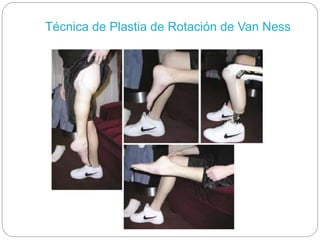 Van Nes Rotation Tumores óseos malignos | PPTX
