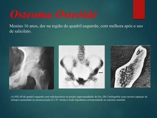 Menino 16 anos, dor na região do quadril esquerdo, com melhora após o uso
de salicilato.
Osteoma Osteóide
(A) RX AP do quadril esquerdo com radioluscência na porção supra-acetabular do ílio. (B) Cintilografia óssea mostra captação de
isótopos aumentada na mesma porção (C) TC mostra a lesão hipodensa correspondendo ao osteoma osteóide.
 