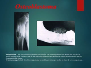 Osteoblastoma
Osteoblastoma: Lesão radioluscente de contornos bem definidos, com resposta periosteal mais pronunciada nas corticais
umeral mediai e lateral, com a extensão de osso reativo circundando o foco radioluscente menor que o do osteoma osteóide.
Osteoma osteóide gigante.
Osteoblastoma periosteal: Osteoblastoma periosteal da mandíbula revestido por um fino invólucro de novo osso periosteal.
 