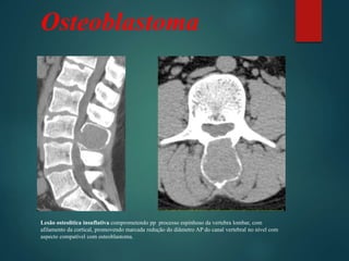 Osteoblastoma
Lesão osteolitica insuflativa comprometendo pp processo espinhoso da vertebra lombar, com
afilamento da cortical, promovendo marcada redução do diâmetro AP do canal vertebral no nível com
aspecto compatível com osteoblastoma.
 