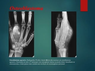 Osteoblastoma
Osteoblastoma agressivo. Radiografias PA (A) e lateral (B) da mão mostram um osteoblastoma
agressivo. Destruição de todo o 4º metacarpo com osteogênese maciça na porção distal. Semelhante ao
osteossarcoma, a lesão parece estar contida num invólucro de neosteogênese periosteal.
 