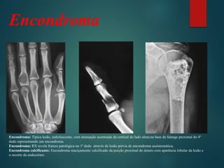 Encondroma
Encondroma: Típica lesão, radioluscente, com atenuação acentuada da cortical do lado ulnar,na base da falange proximal do 4º
dedo representando um encondroma.
Encondroma: RX revela fratura patológica no 1º dedo através de lesão prévia de encondroma assintomática.
Encondroma calcificante: Encondroma maciçamente calcificado da porção proximal do úmero com aparência lobular da lesão e
o recorte da endocórtex.
 