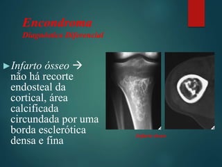 Encondroma
Diagnóstico Diferencial
►Infarto ósseo 
não há recorte
endosteal da
cortical, área
calcificada
circundada por uma
borda esclerótica
densa e fina
Infarto ósseo
 