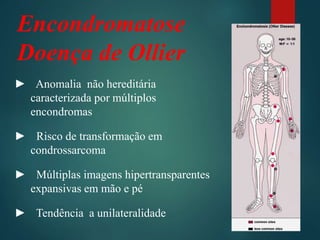 Encondromatose
Doença de Ollier
► Anomalia não hereditária
caracterizada por múltiplos
encondromas
► Risco de transformação em
condrossarcoma
► Múltiplas imagens hipertransparentes
expansivas em mão e pé
► Tendência a unilateralidade
 