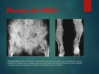 Doença de Ollier
Doença de Ollier: (A) RX AP da pelve com calcificações em forma de crescente lunar e semelhantes a anel nas
projeções de cartilagem que se estendem a partir das cristas ilíacas e das porções proximais dos fêmures. (B) RX
de ambas as pernas com parada do crescimento e deformidades da tíbia e da fíbula.
 