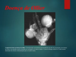 Doença de Ollier
Condrossarcoma na doença de Ollier: Transformação sarcomatosa do encondroma da mão de um paciente com doença
de Ollier, com grandes massas lobuladas de cartilagem em todos os dedos. A lesão da falange média do 4º dedo mostra
destruição da cortical e disseminação para os tecidos moles.
 