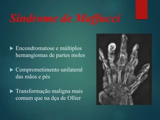 Síndrome de Maffucci
 Encondromatose e múltiplos
hemangiomas de partes moles
 Comprometimento unilateral
das mãos e pés
 Transformação maligna mais
comum que na dça de Ollier
 
