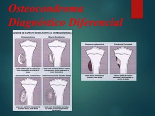 Osteocondroma
Diagnóstico Diferencial
 