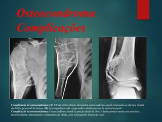 Osteocondroma
Complicações
Complicação de osteocondroma: (A) RX do ombro direito demonstra osteocondroma séssil originando-se da face medial
da diáfise proximal do úmero. (B) Arteriografia revela compressão e deslocamento da artéria braquial.
Complicação de osteocondroma: Osteocondroma séssil na porção distai da tíbia. A lesão produz erosão por pressão e,
posteriormente, abaulamento e afilamento da fíbula, com subsequente fratura do osso.
 