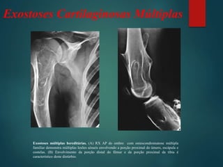 Exostoses Cartilaginosas Múltiplas
Exostoses múltiplas hereditárias. (A) RX AP do ombro com osteocondromatose múltipla
familiar demonstra múltiplas lesões sésseis envolvendo a porção proximal do úmero, escápula e
costelas. (B) Envolvimento da porção distal do fêmur e da porção proximal da tíbia é
característico deste distúrbio.
 