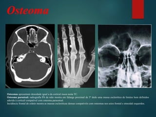 Osteoma
Osteomas apresentam densidade igual a da cortical óssea nesta TC.
Osteoma parosteal: radiografia PA da mão mostra em falange proximal de 3º dedo uma massa esclerótica de limites bem definidos
aderida à cortical compatível com osteoma paraosteal.
Incidência frontal do crânio mostra as massas escleróticas densas compativéis com osteomas nos seios frontal e etmoidal esquerdos.
 