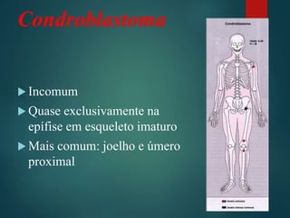 Condroblastoma
 Incomum
 Quase exclusivamente na
epífise em esqueleto imaturo
 Mais comum: joelho e úmero
proximal
 
