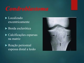 Condroblastoma
 Localizado
excentricamente
 Borda esclerótica
 Calcificações esparsas
na matriz
 Reação periosteal
espessa distal a lesão
 